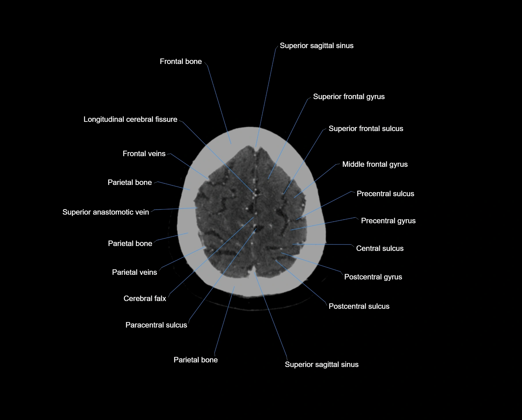CT scan brain axial labelled cross sectional anatomy image-img-000063.webp